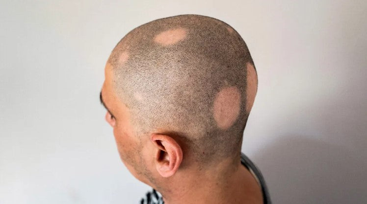 alopecia treatment