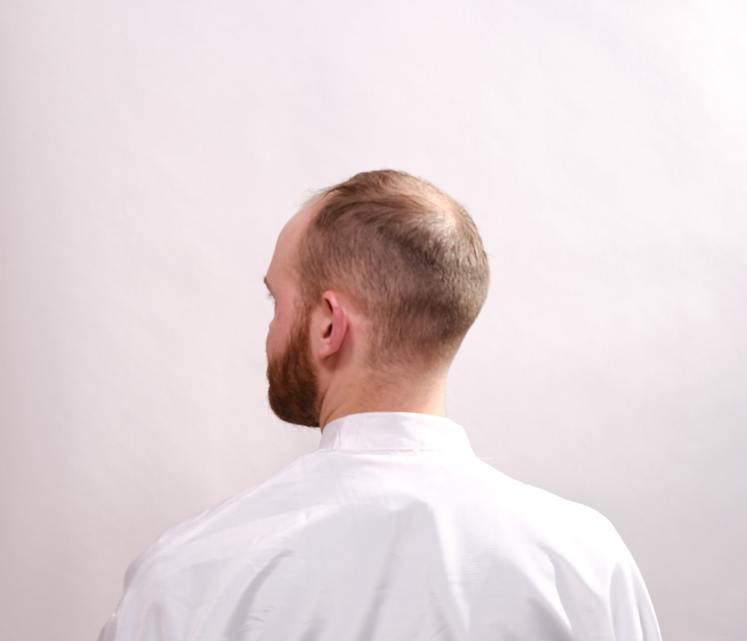 male pattern baldness