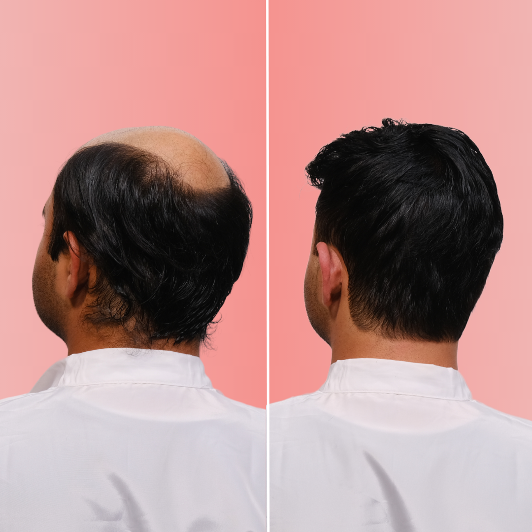 men's hair replacement system before after