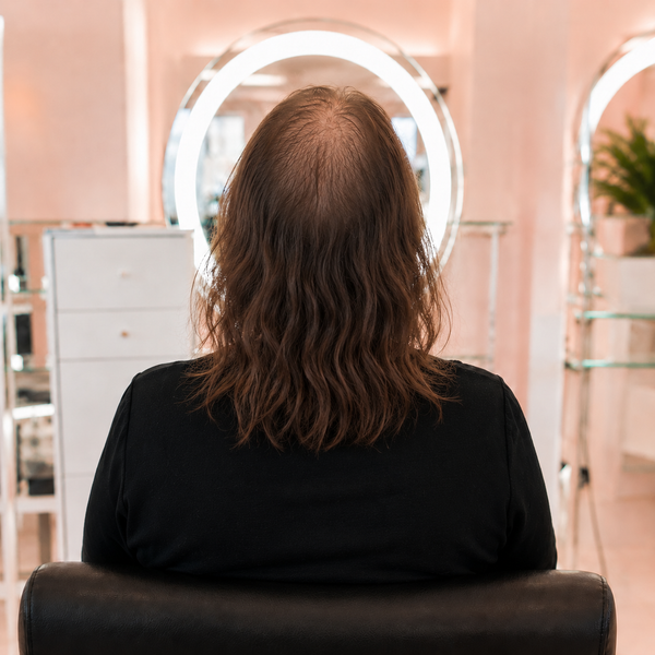 Before — Natural Hairline Restoration