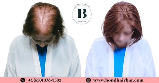 Causes of Hair Loss in Women & Treatment