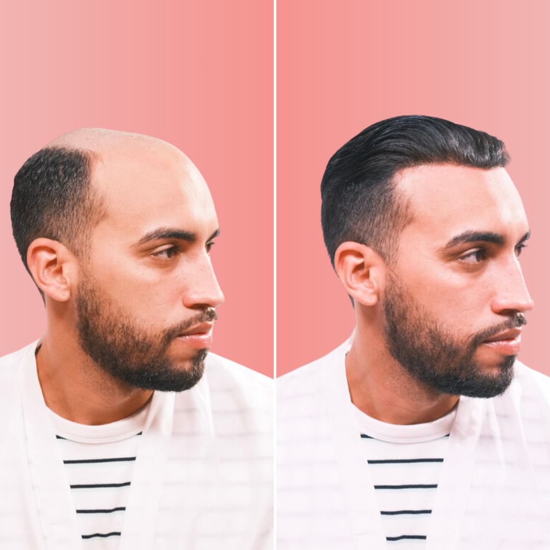 men's hair replacement before and after